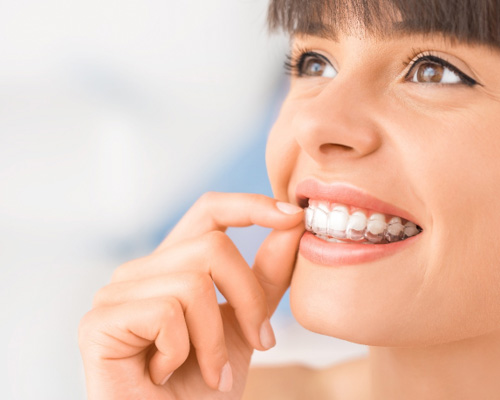 A woman putting on an Invisalign tray