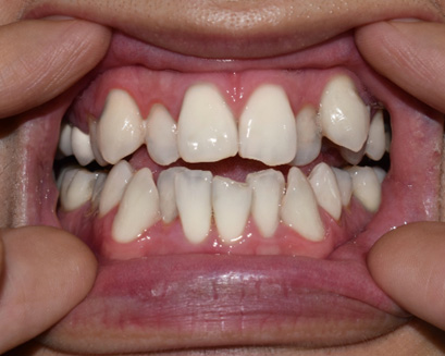 A person with crowded teeth