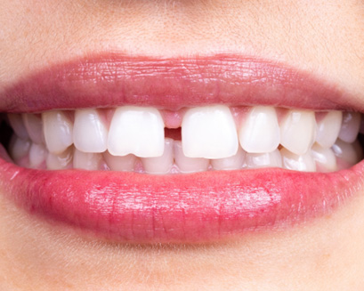 A woman with gapped teeth
