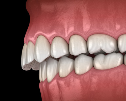 A CGI of a person with an overbite