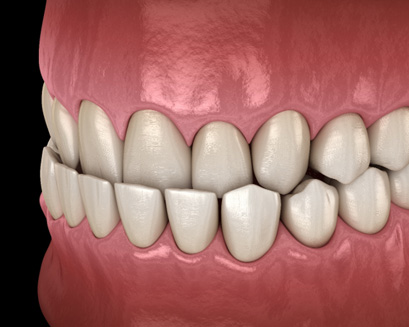 A CGI of a person with an underbite
