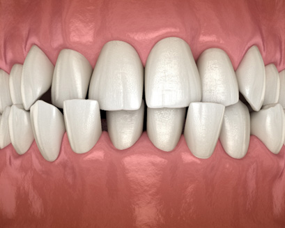 A CGI of a person with a crossbite