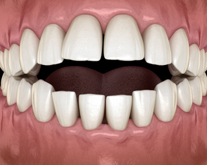 A CGI of a person with an open bite